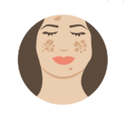 Benign pigmented lesions (including melasma)